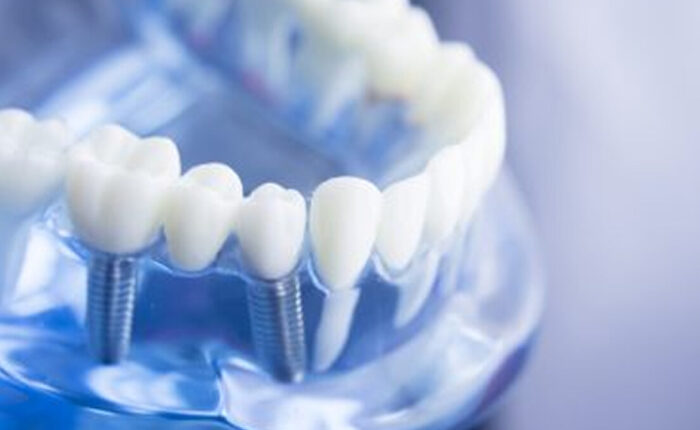 dental implants west hollywood ca
