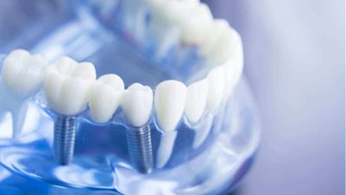 dental implants west hollywood ca